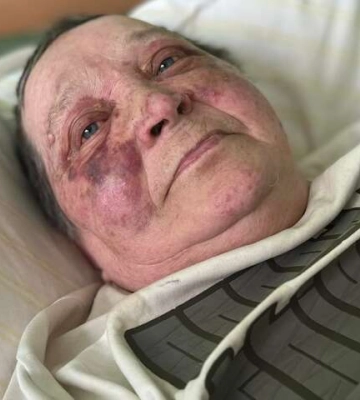 Россияне жестоко избили 70-летнюю волонтерку из Херсона 