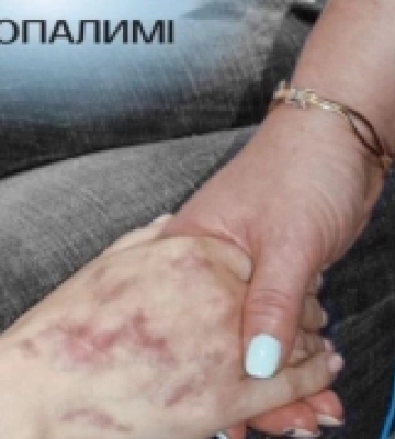 Рівненщина долучилась до проєкту «Неопалимі» із естетичної медицини для потерпілих внаслідок війни