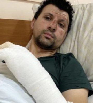 У Львові госпіталізували двох чоловіків з важкими опіками, отриманими внаслідок вибухів акумуляторів