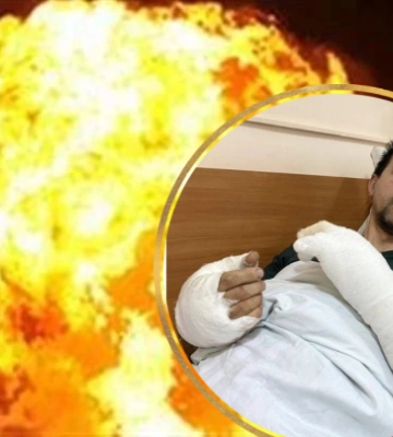 Акумулятори ледь не &quot;вбили&quot; двох чоловіків на Заході України: людям пересаджували шкіру