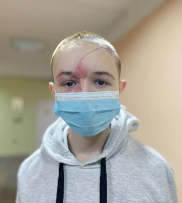У черепі була дірка - 8 см: хлопчику з Харківщини повертають обличчя у Львові