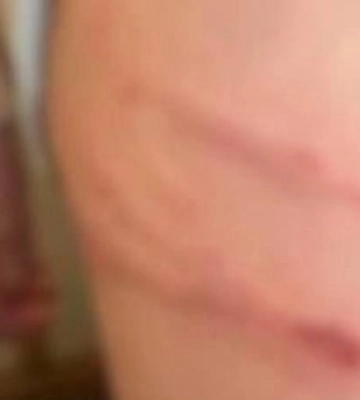 Січені рани на тілі: вихователька в дитячому садочку катувала дитину 