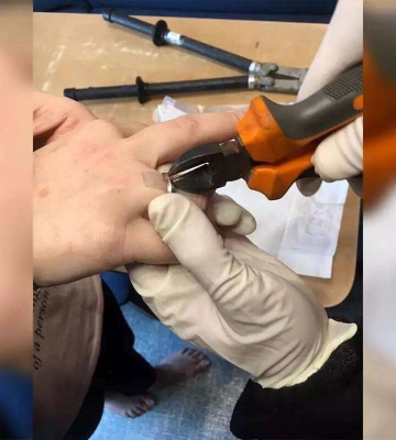 У Дніпрі рятувальники двічі на день знімали каблучки з пальців жінок