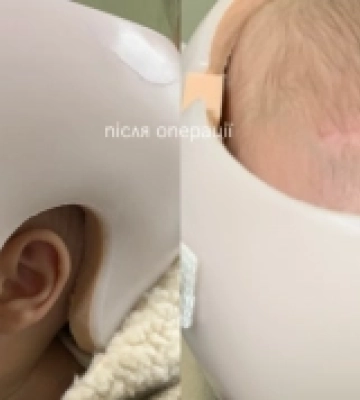 Рівненські медики провели дітям дві унікальні операції на черепі