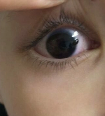 Играл маникюрными ножницами: в Ровно спасли зрение 5-летнему мальчику, который поранил глаз