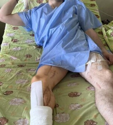 Поранений під час оборони Харкова боєць ТрО Дмитро Олійник переніс 14 операцію