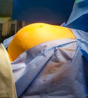 На Кіровоградщині лікарі видалили пухлину вагою майже 20 кілограмів