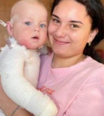 Львівські лікарі врятували 9-місячного хлопчика, який обпік чверть поверхні тіла
