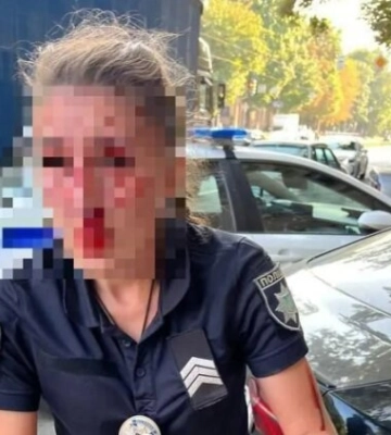 Переламаний ніс та кістки обличчя: з&#039;явилися дані про стан патрульної, яку побив водій Jaguar у Дніпрі