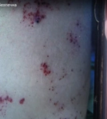 На Волині медики діагностували у чоловіка рідкісну та небезпечну хворобу. ВІДЕО