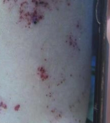 Хвороба Фабрі: на Волині діагностували рідкісну й дуже небезпечну недугу