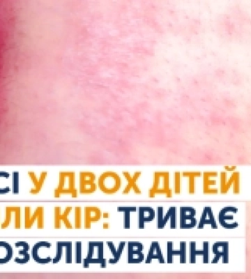 В Одесі зареєстрували спалах кору: триває епідрозслідування