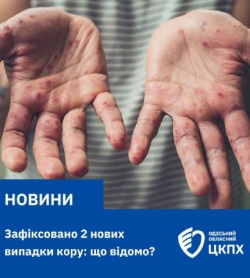 В Одесі зафіксовано нові випадки кору