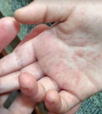 З початку року в Україні виявили п&#039;ять випадків кору, з них чотири – на Волині та Одещині