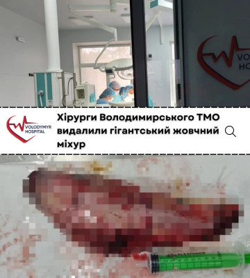 На Волині медики видалили гігантський жовчний міхур