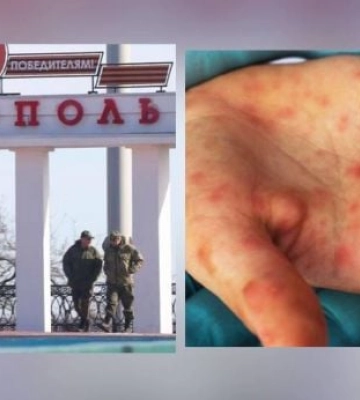 В Мелитополе началась эпидемия кори – больницы переполнены, а оккупанты не знают, что делать