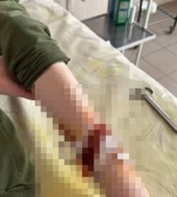 У Нововолинську безпритульний собака покусав 9-річного хлопчика: що каже мер (відео)