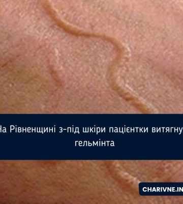 На Рівненщині з-під шкіри пацієнтки витягнули гельмінта