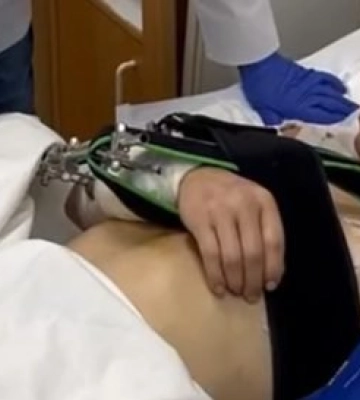 Потрапив під російський обстріл: у Дніпрі рятують хлопця з Нікопольщини