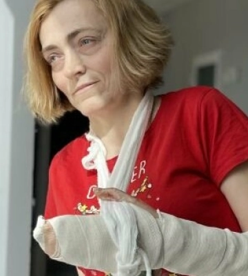 Львівські медики розділили жінці нерухомі пальці руки, які за 30 років зрослися