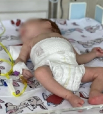 Закарпатські хірурги прооперували новонародженого хлопчика з вивернутими назовні органами