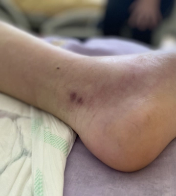 У гірському селі на Львівщині змія вкусила в ногу 26-річного чоловіка