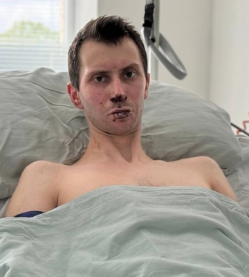 «Я горів у траншеї, витягнули просто з вогню»: волинського захисника із 50% опіками тіла нині лікують у Львові