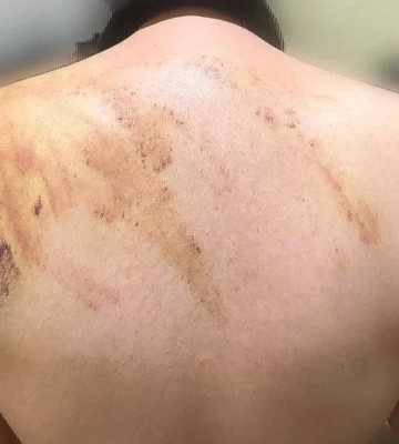 У Коломиї побили підопічну психоневрологічного інтернату