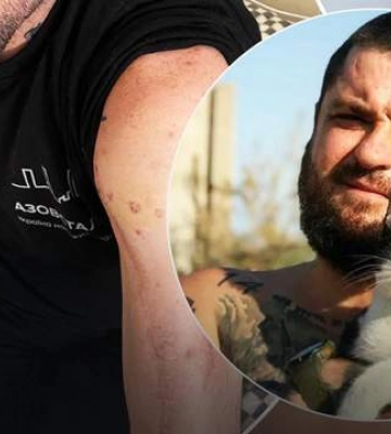 Александру &quot;Медведю&quot; Кравцову в плену сломали руку, которую едва собрали после ранения в ДАП