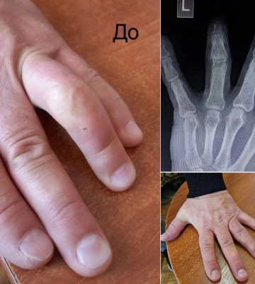 У Сумах вперше виконали ендопротезування міжфалангового суглоба пальця руки