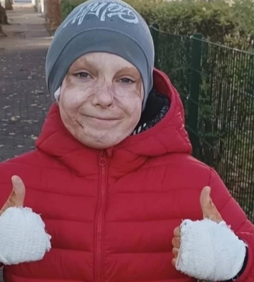 Носив два роки. Лікарі зняли синю компресійну маску з хлопчика, який внаслідок атаки по Вінниці отримав 45% опіків тіла