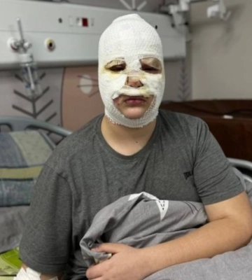 На Львівщині троє підлітків виготовляли за інструкцією ТікТоку «петарду». Страшні наслідки