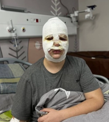 На Львівщині госпіталізували трьох незнайомих між собою хлопців, які робили петарди за інструкцією із ТікТок