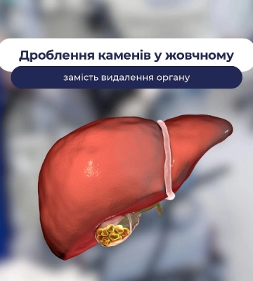 В Одесі провели унікальну операцію з видалення каменів жовчного міхура