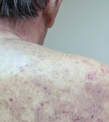 Під час виїзного обстеження у Нововолинську виявили три випадки раку шкіри