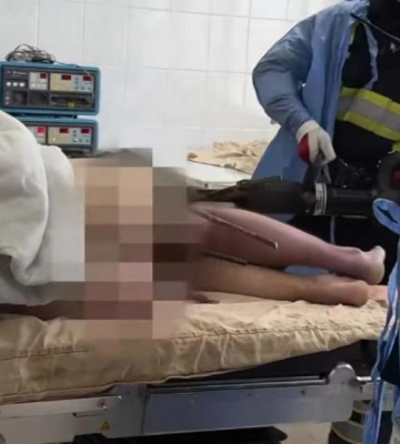У Рівному оперують чоловіка, який наштрикнувся на арматуру