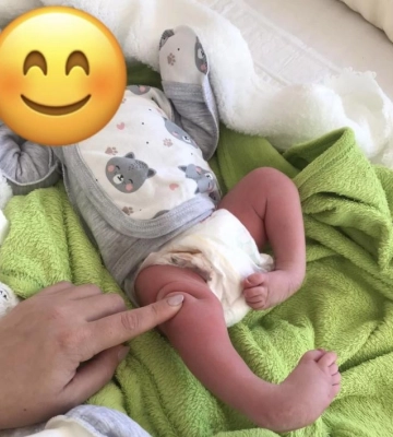 У Рівному медики допомогли немовляті з важкою формою клишоногості (ФОТО)