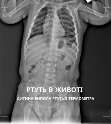 У Рівному дитина випила ртуть із термометра