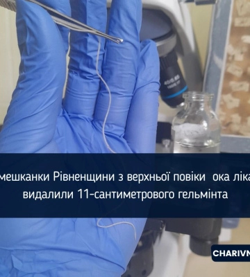 На Рівненщині у жінки з повіки видалили 11 сантиметрового гельмінта