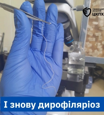 11-сантиметрового паразита, якого переносять комарі, дістали з ока жительки Рівненщини