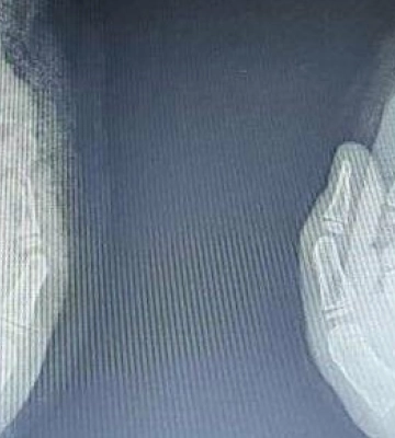 У Львові лікарі врятували обидві руки 5-річному хлопчику після тяжкої травми