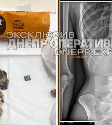 Жителька Дніпра опинилася у лікарні через батончик: виробник відреагував на скандал