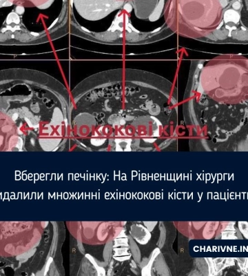 Вберегли печінку: На Рівненщині хірурги видалили множинні ехінококові кісти у пацієнтки