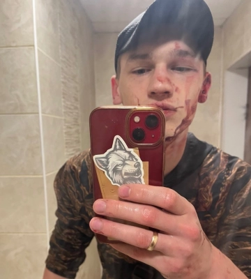 У Золотоноші побили військового на реабілітації. За справу взялася поліція