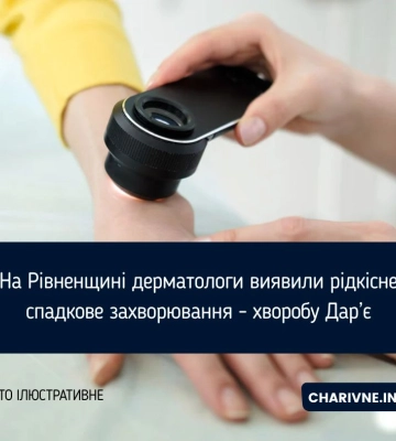 У Костополі під час виїзного прийому виявили рідкісне генетичне захворювання шкіри