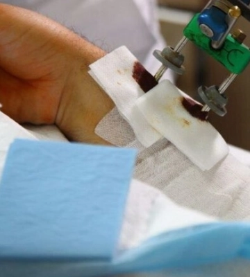 Докладають усіх зусиль для уникнення ампутацій: лікарі Дніпра продовжують рятувати поранених з передової