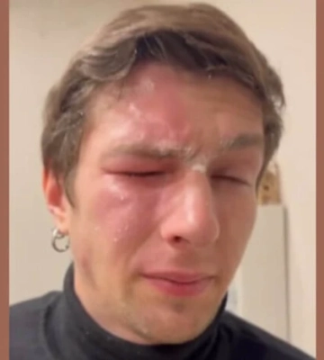 У Львові сусідка розпилила перцевий балончик в обличчя ветерану. Поліція відреагувала 