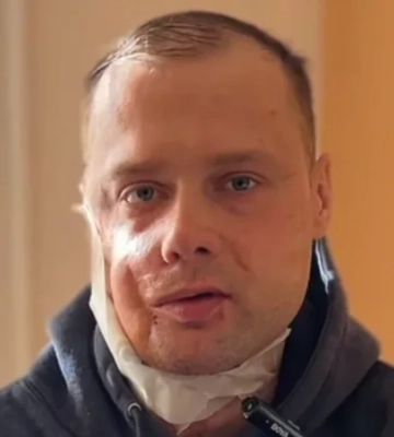 Львівські хірурги реконструювали обличчя ветерану після 18 операцій