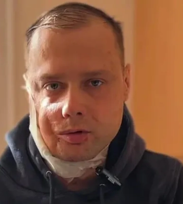 Львівські хірурги реконструювали обличчя ветерану після 18 операцій