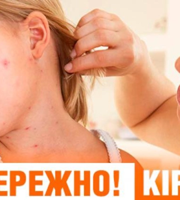 На Закарпатті знову фіксуються випадки кору